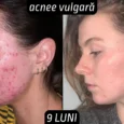 Rezultate tretinoin acnee vulgara femei 9 luni