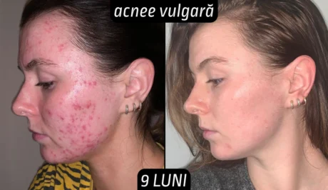 Rezultate tretinoin acnee vulgara femei 9 luni